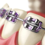 braces - orthodontic treatment